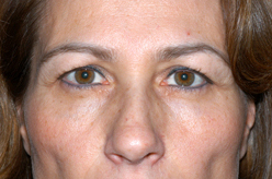 Blepharoplasty