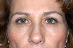 Blepharoplasty