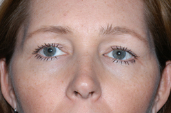 Blepharoplasty