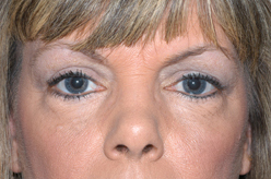 Blepharoplasty