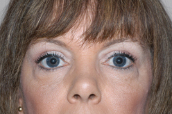 Blepharoplasty