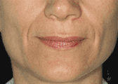 Dermal Fillers