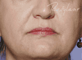 Dermal Fillers