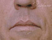 Dermal Fillers