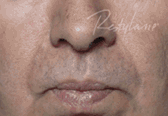 Dermal Fillers