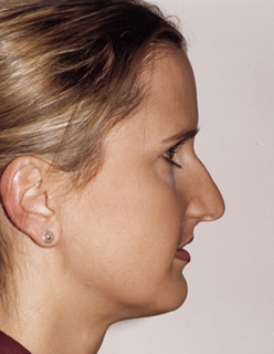 Rhinoplasty for Women