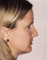 Rhinoplasty for Women