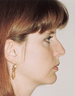 Rhinoplasty for Women