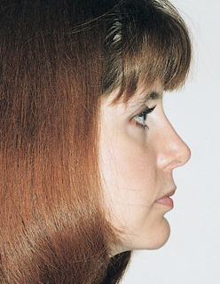 Rhinoplasty for Women