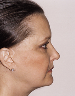 Rhinoplasty for Women