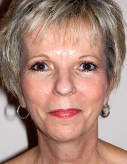 Rhinoplasty for Women Case 2206 Before Photo Rhinoplasty for Women