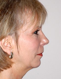 Rhinoplasty for Women Case 2206 After Photo Rhinoplasty for Women