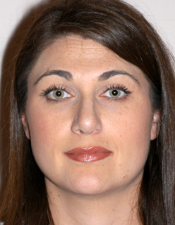Rhinoplasty for Women Case 2238 After Photo Rhinoplasty for Women