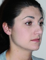 Rhinoplasty for Women