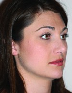 Rhinoplasty for Women