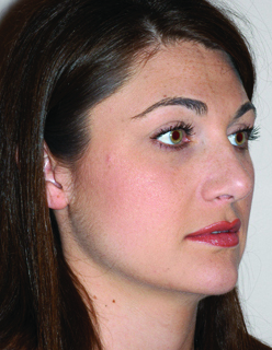 Rhinoplasty for Women Case 2238 After Photo Rhinoplasty for Women