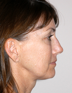 Rhinoplasty for Women