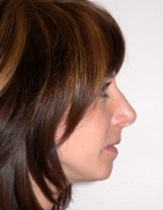 Rhinoplasty for Women