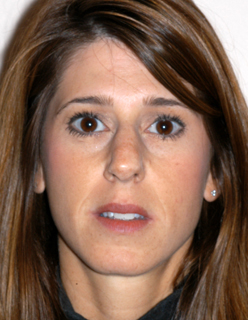 Rhinoplasty for Women Case 2311 Before Photo Rhinoplasty for Women