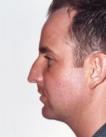 Rhinoplasty for Men