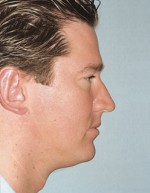 Rhinoplasty for Men