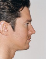 Rhinoplasty for Men