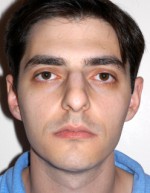 Rhinoplasty for Men