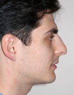 Rhinoplasty for Men