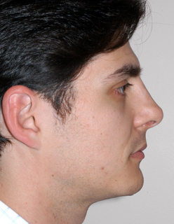 Rhinoplasty for Men