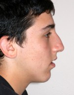 Rhinoplasty for Men