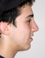 Rhinoplasty for Men