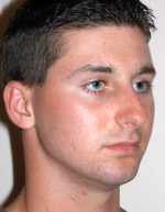 Rhinoplasty for Men