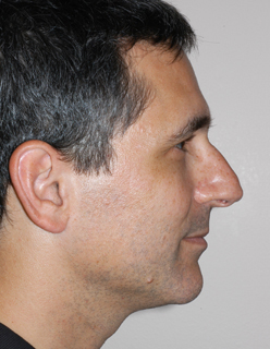 Rhinoplasty for Men