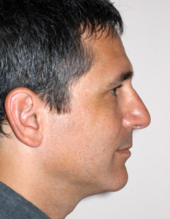 Rhinoplasty for Men Case 2250 After Photo Rhinoplasty for Men