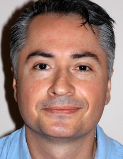 Rhinoplasty for Men Case 2270 Before Photo Rhinoplasty for Men