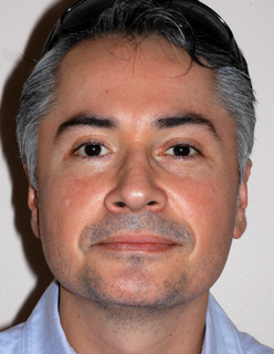 Rhinoplasty for Men Case 2270 After Photo Rhinoplasty for Men
