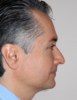 Rhinoplasty for Men Case 2270 Before Photo Rhinoplasty for Men