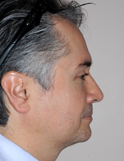 Rhinoplasty for Men Case 2270 After Photo Rhinoplasty for Men