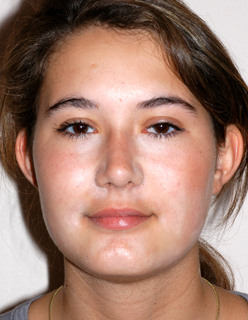 Rhinoplasty for Teens