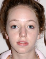 Rhinoplasty for Teens