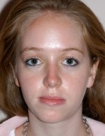 Rhinoplasty for Teens