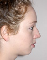 Rhinoplasty for Teens