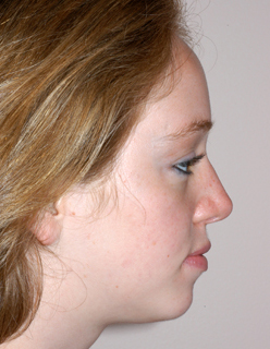 Rhinoplasty for Teens