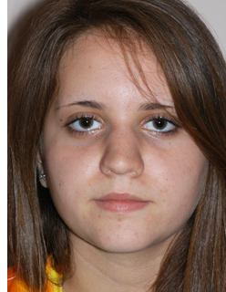 Rhinoplasty for Teens