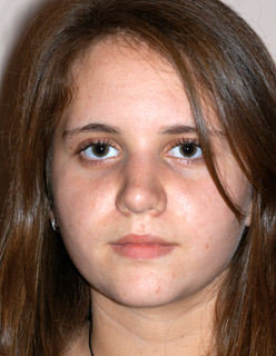 Rhinoplasty for Teens