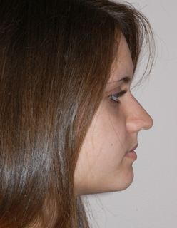 Rhinoplasty for Teens