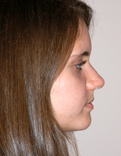 Rhinoplasty for Teens