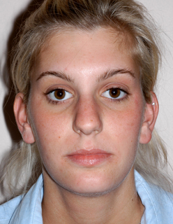 Rhinoplasty for Teens