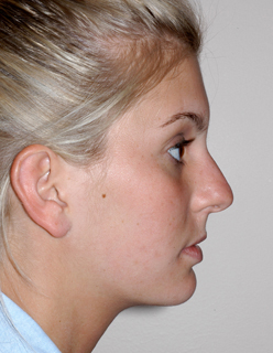 Rhinoplasty for Teens