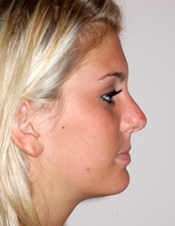 Rhinoplasty for Teens